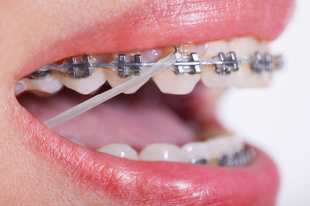 Elastics For Braces | Yakima Orthodontics Elastics For Braces | Yakima Orthodontics