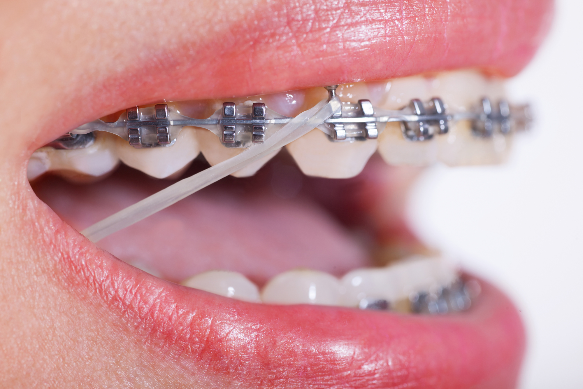 Elastics For Braces | Parker Orthodontics Elastics For Braces | Parker Orthodontics