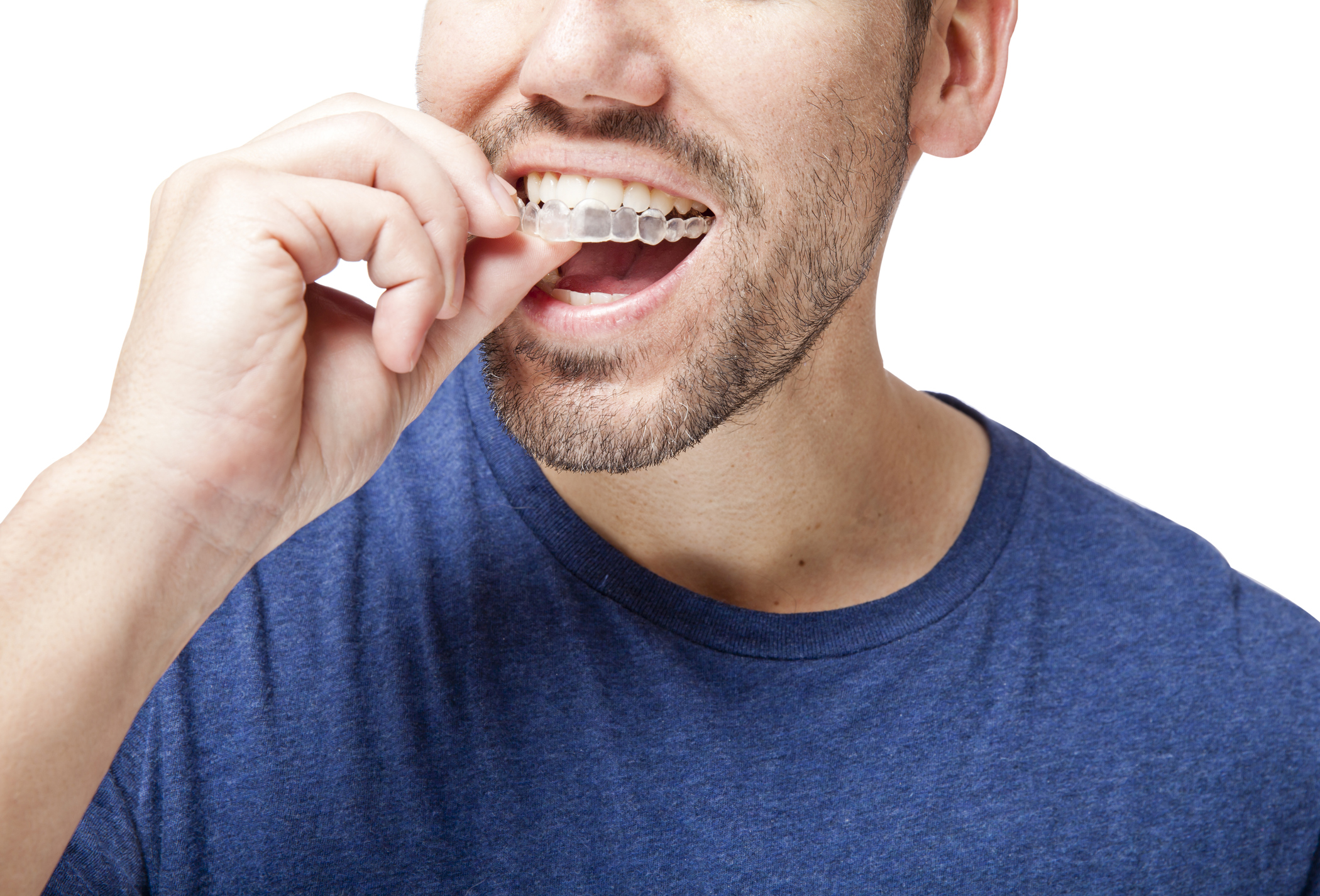 Ellensburg Invisalign | Parker Orthodontics Ellensburg Invisalign | Parker Orthodontics