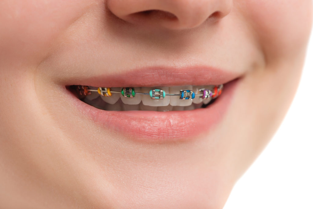 Metal Braces | Yakima Orthodontics Metal Braces | Yakima Orthodontics