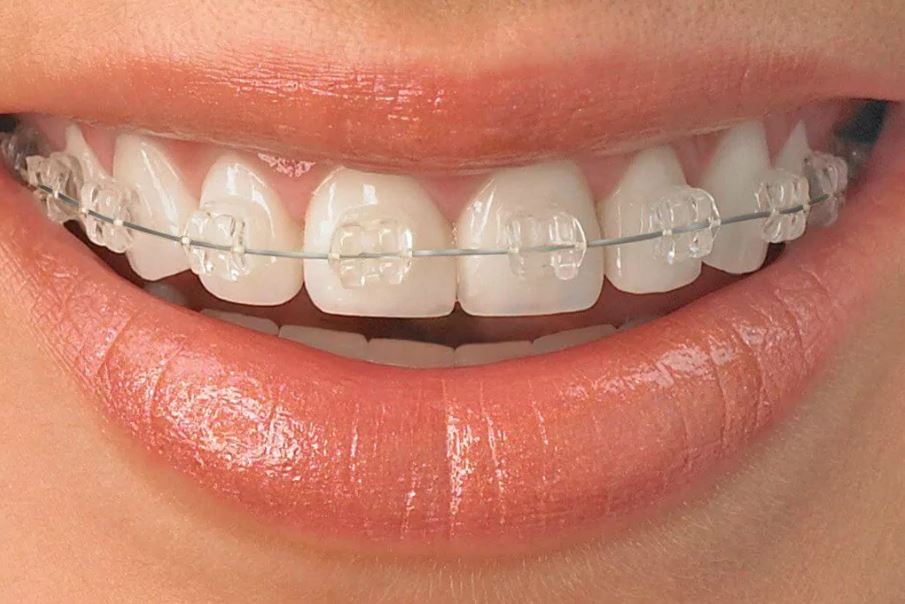 You are currently viewing Are Ceramic Braces Better than Metal Braces?